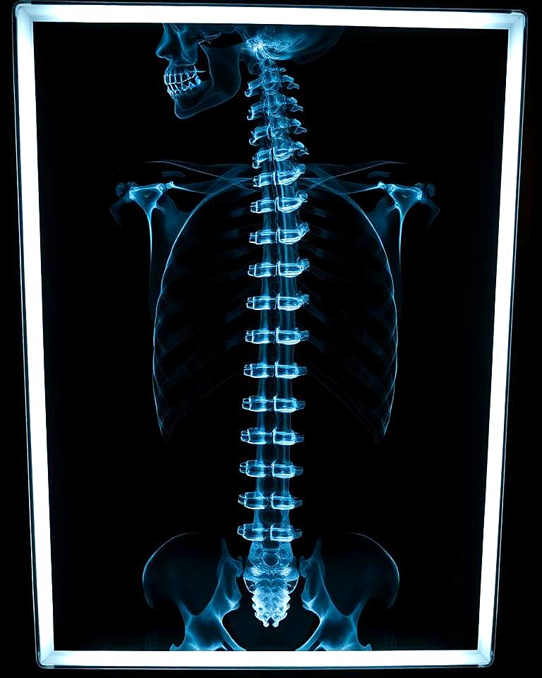 Spinal Cord Injury